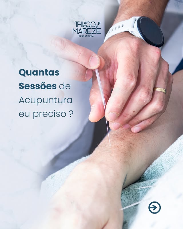 Sessão individualizada de acupuntura